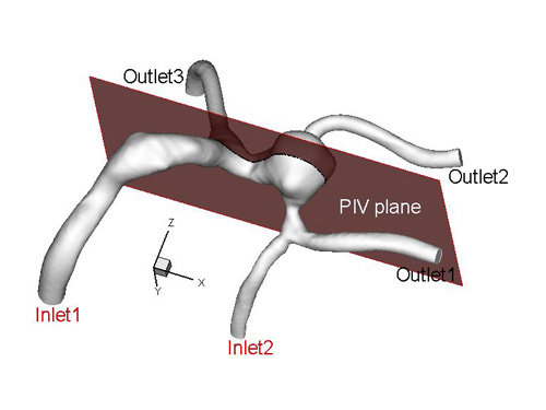 Computational modelization (CFD) of patient specific brain aneurysms for the prediction of the formation, growth and rupture of the aneurysm